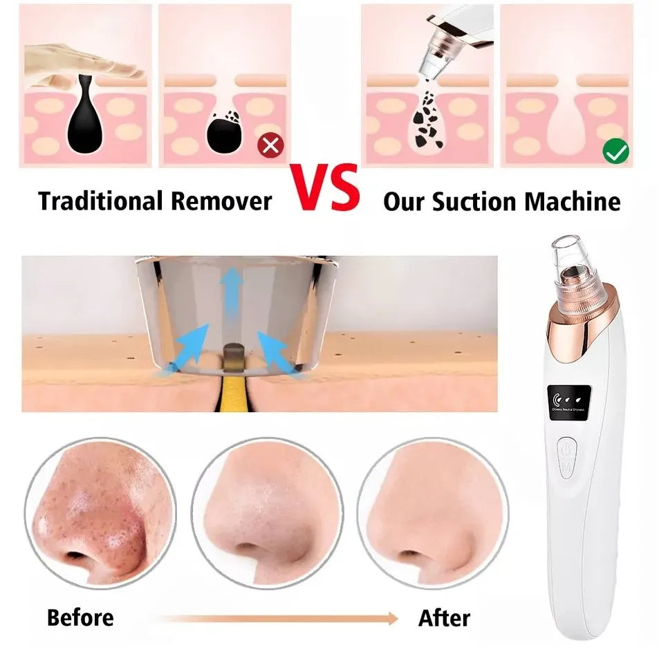 5-in-1 Rechargeable Blackhead Remover – Deep Pore Facial Vacuum